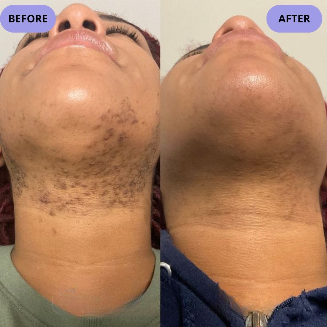 Dark Spot Serum for Normal Skin