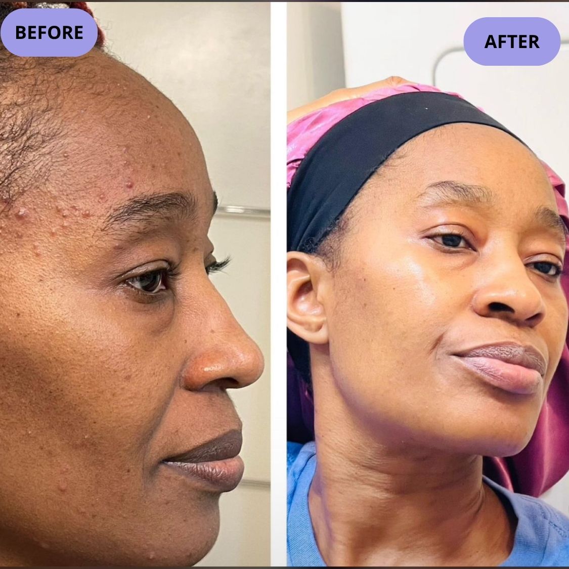 Dark Spot Serum for Normal Skin