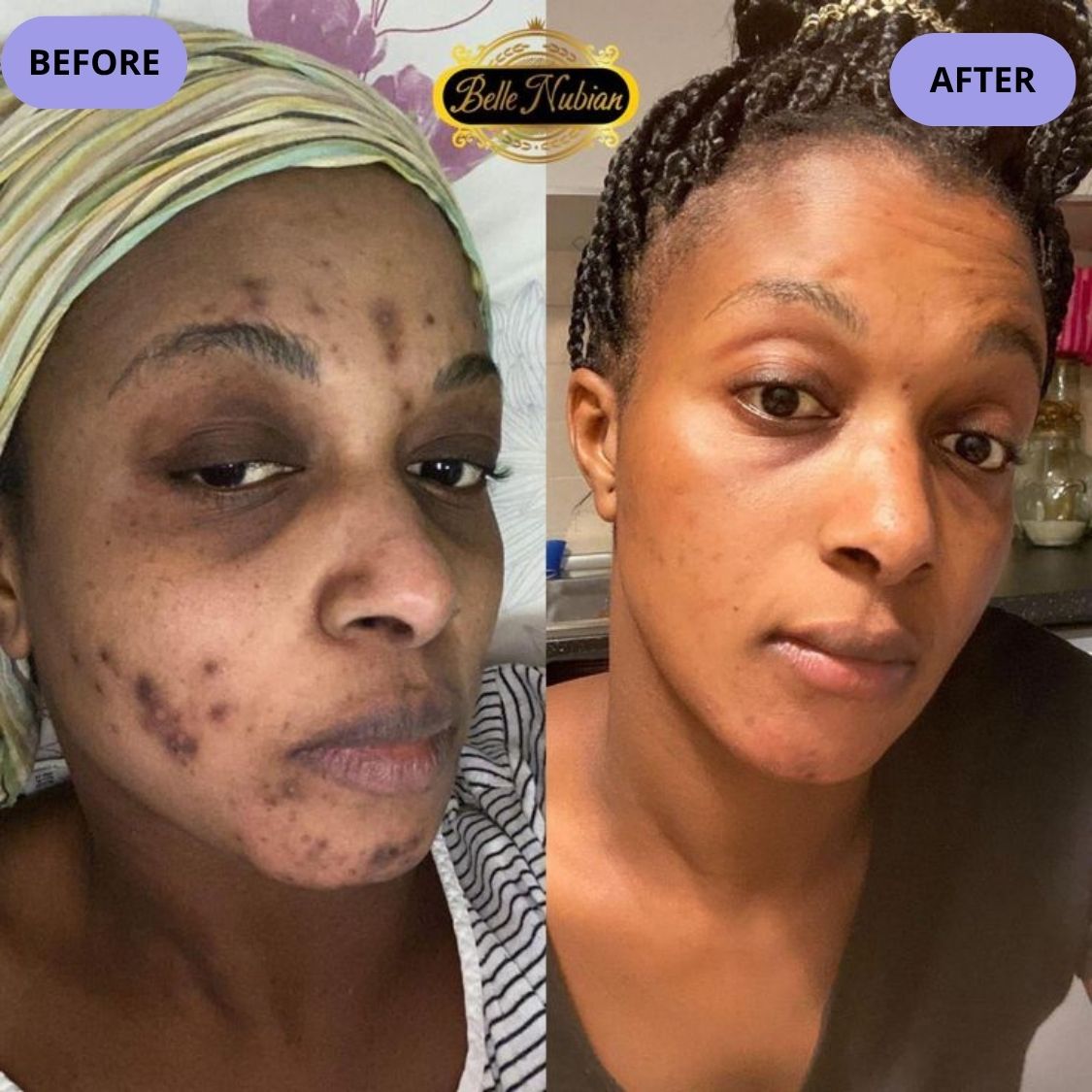 Dark Spot Serum for Normal Skin
