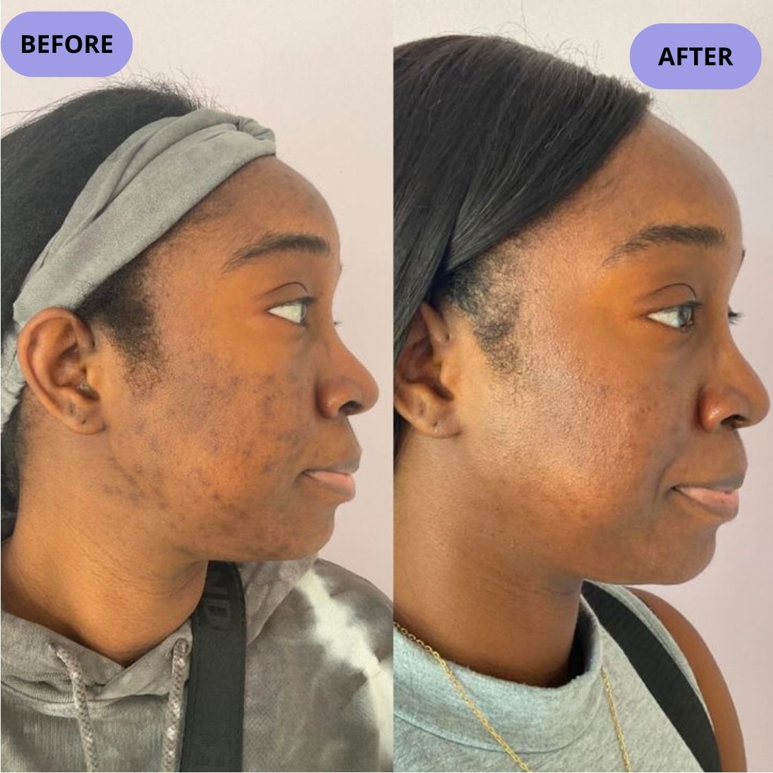 Dark Spot Serum for Normal Skin